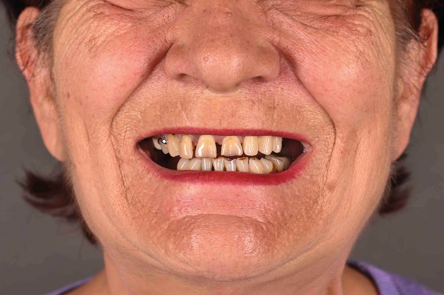 Pacient Clinica Dr. Alin Odor - Rezultat Implantologie